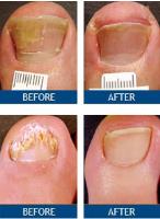 Toenail Fungus Removal - New Haven, CT image 3